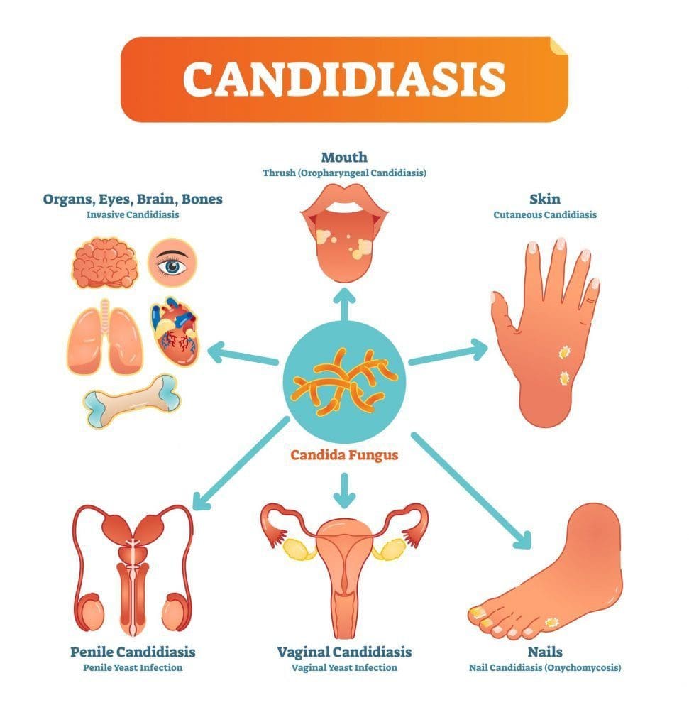 Candida Albicans Ibs Clinics